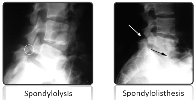 spondylolysis-spondylolisthesis.jpg-eng.png