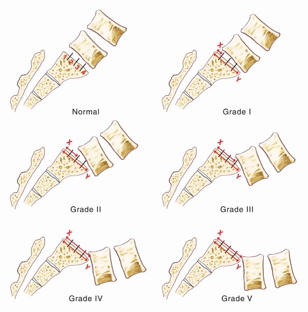 grade 3 spondylolisthesis symptoms